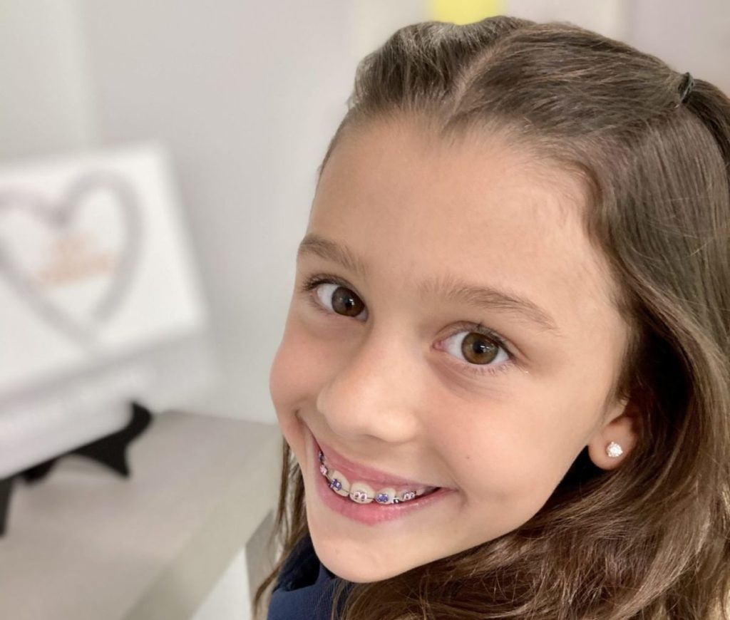 Everything You Need to Know About Palatal Expanders